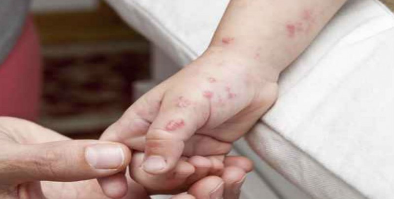 Niegan alerta epidemiológica por casos de virus coxsackie