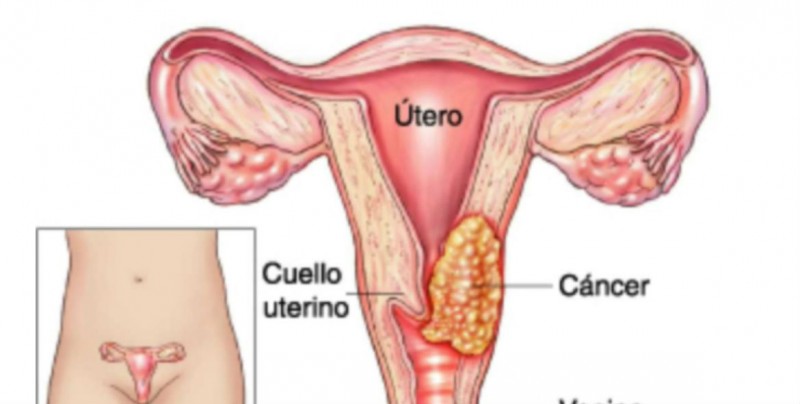 Ponen en marcha la Semana de sensibilización del Cáncer de Cuello Uterino