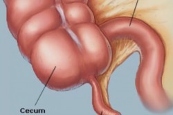 Síntomas de apendicitis, esté al pendiente