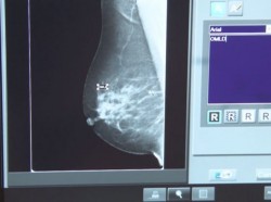 Al año se detectan 300 pacientes con cáncer de mama