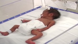 Hoy es el Día Mundial del Niño Prematuro
