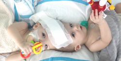 VIDEO: Separaron a gemelos unidos por la cabeza
