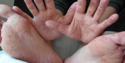 Emiten alerta sanitaria por brotes del virus Coxsackie