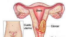 Ponen en marcha la Semana de sensibilización del Cáncer de Cuello Uterino