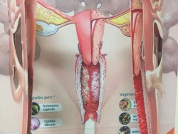 Semana contra el cáncer del cuello de la matriz