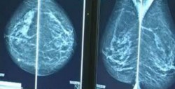 Cada año se reportan seis mil muertes por cáncer de mama en el país